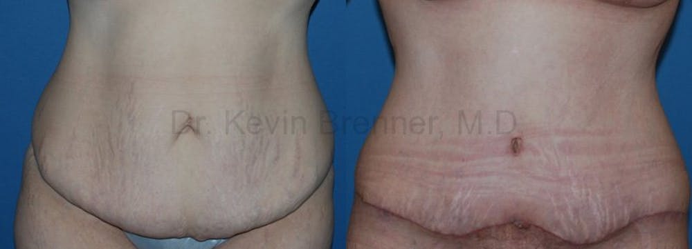 Body Contouring Before & After Gallery - Patient 1482413 - Image 1