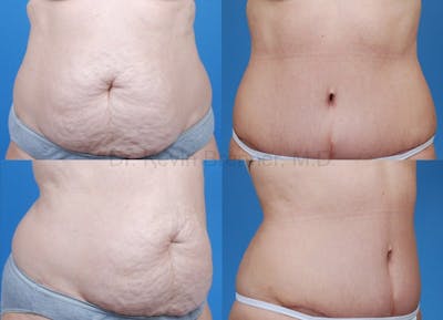 Before and after of tummy tuck in Beverly Hills 1