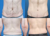 Body Contouring Before & After Gallery - Patient 1482415 - Image 1