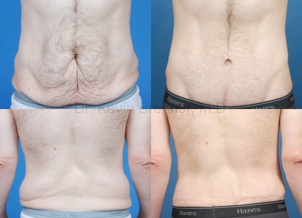 Body Contouring Before & After Gallery - Patient 1482415 - Image 1