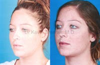 Liposuction Before & After Gallery - Patient 1482417 - Image 1