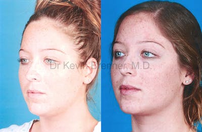Liposuction Gallery - Patient 1482417 - Image 1