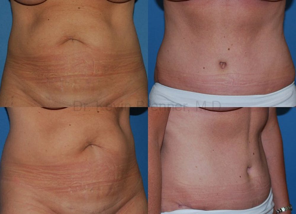 Tummy Tuck Before & After Gallery - Patient 1482416 - Image 1