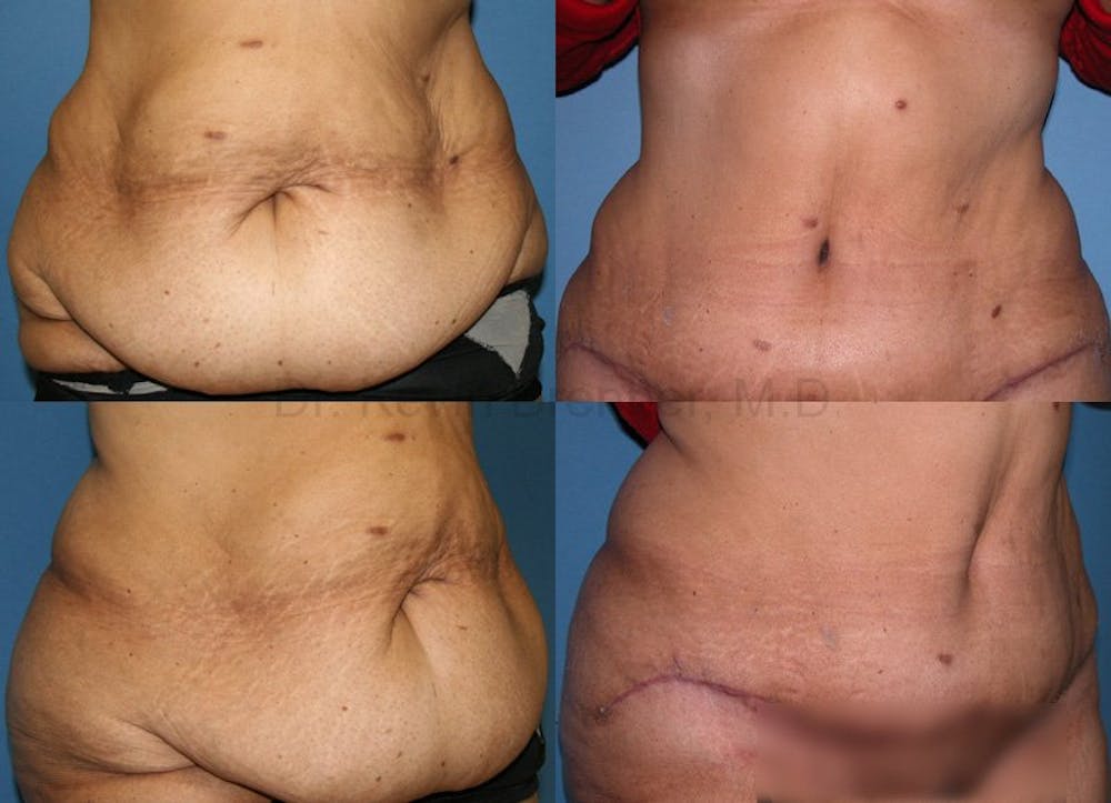 Body Contouring Before & After Gallery - Patient 1482418 - Image 1