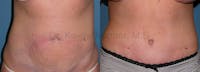 Tummy Tuck Before & After Gallery - Patient 1482419 - Image 1