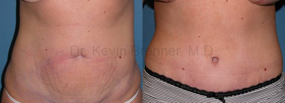 Tummy Tuck Before & After Gallery - Patient 1482419 - Image 1