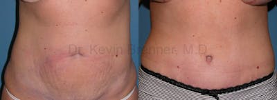 Tummy Tuck Before & After Gallery - Patient 1482419 - Image 1