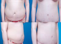 Body Contouring Before & After Gallery - Patient 1482420 - Image 1