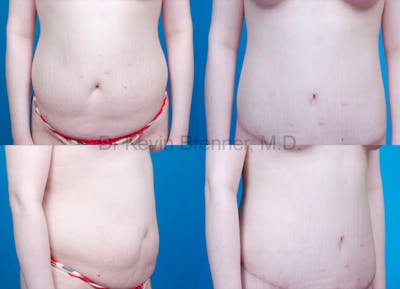 Body Contouring Before & After Gallery - Patient 1482420 - Image 1
