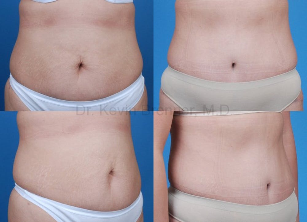 Tummy Tuck Before & After Gallery - Patient 1482421 - Image 1