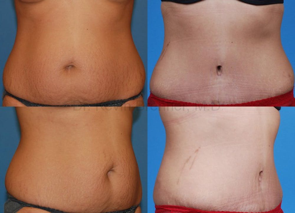 Tummy Tuck Before & After Gallery - Patient 1482423 - Image 1