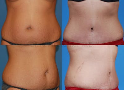 Tummy Tuck Before & After Gallery - Patient 1482423 - Image 1