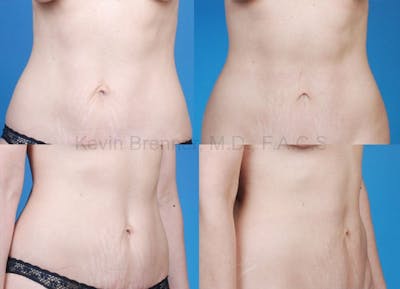 Tummy Tuck Before & After Gallery - Patient 1482425 - Image 1