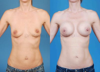 Mommy Makeover Before & After Gallery - Patient 1482424 - Image 1