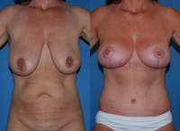 Mommy Makeover Before & After Gallery - Patient 1482428 - Image 1
