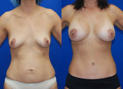 Mommy Makeover Before & After Gallery - Patient 1482430 - Image 1