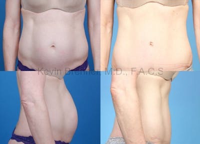 Tummy Tuck Before & After Gallery - Patient 1482431 - Image 1
