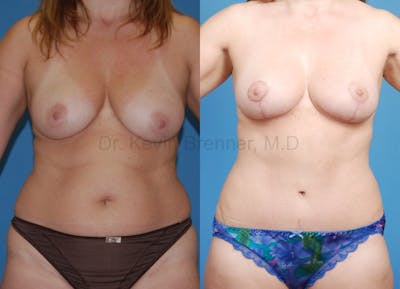 beverly hills mommy makeover before and after 1
