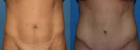 Tummy Tuck Before & After Gallery - Patient 1482435 - Image 1