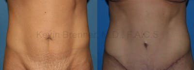 Tummy Tuck Before & After Gallery - Patient 1482435 - Image 1