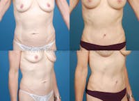 Umbilical Hernia Repair Before & After Gallery - Patient 1482436 - Image 1