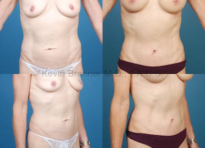 Umbilical Hernia Repair Before & After Gallery - Patient 1482436 - Image 1