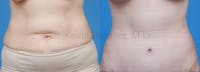 Tummy Tuck Before & After Gallery - Patient 1482438 - Image 1