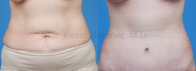 Tummy Tuck Before & After Gallery - Patient 1482438 - Image 1
