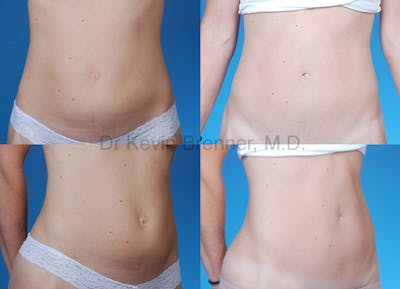 Umbilical Hernia Repair Before & After Gallery - Patient 1482439 - Image 1