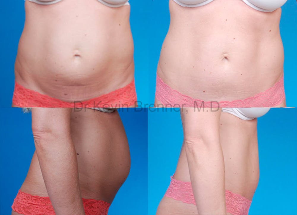Tummy Tuck Before & After Gallery - Patient 1482441 - Image 1