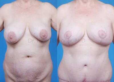 Mommy Makeover Before & After Gallery - Patient 1482442 - Image 1