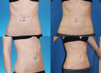 Umbilical Hernia Repair Before & After Gallery - Patient 1482443 - Image 1