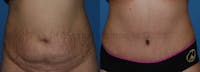 Tummy Tuck Before & After Gallery - Patient 1482444 - Image 1