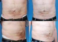 Umbilical Hernia Repair Before & After Gallery - Patient 1482447 - Image 1