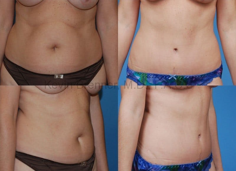 Before and after of tummy tuck in Beverly Hills 4