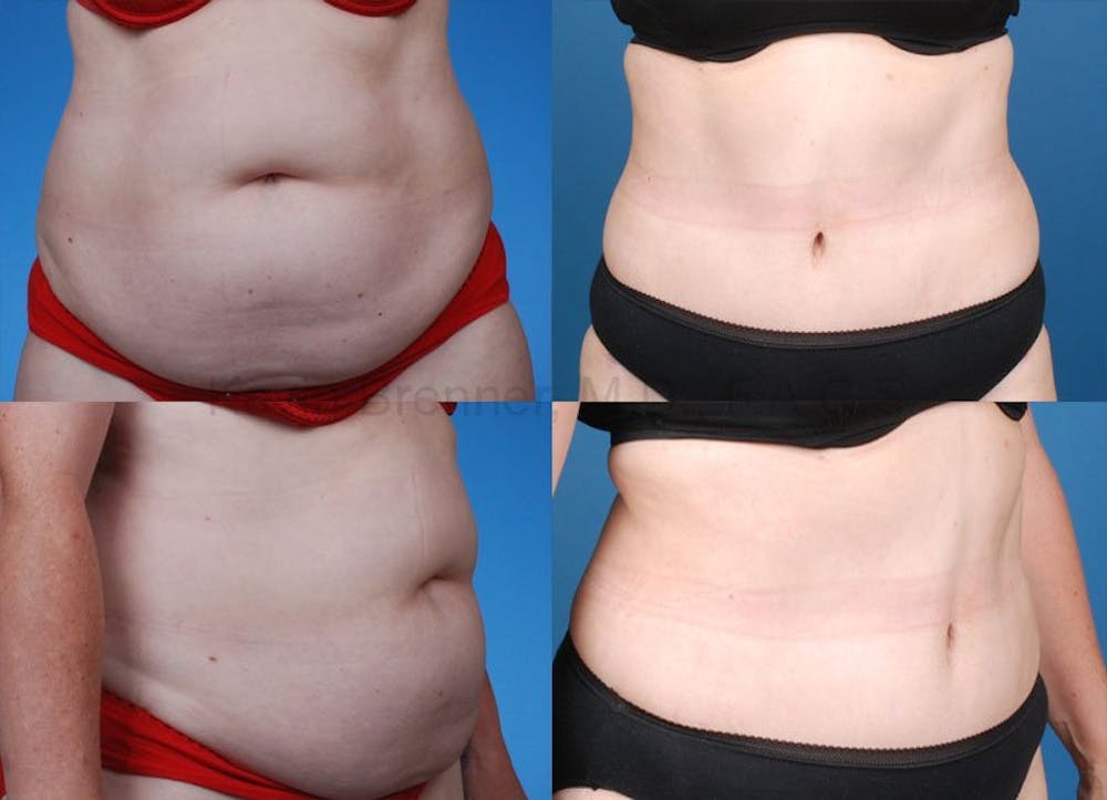 Tummy Tuck Before & After Gallery - Patient 1482448 - Image 1