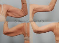 Brachioplasty Before & After Gallery - Patient 1482450 - Image 1