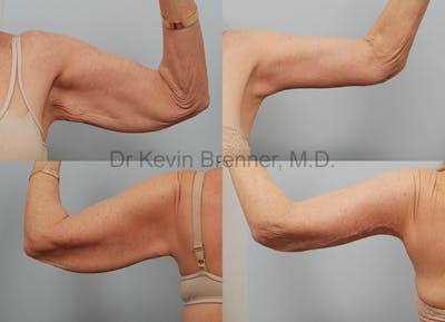 Brachioplasty Before & After Gallery - Patient 1482450 - Image 1