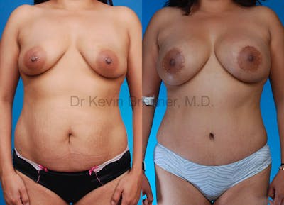 Mommy Makeover Before & After Gallery - Patient 1482449 - Image 1