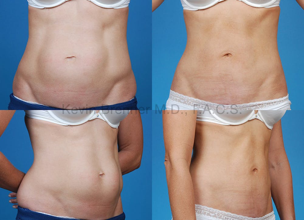 Umbilical Hernia Repair Before & After Gallery - Patient 1482451 - Image 1
