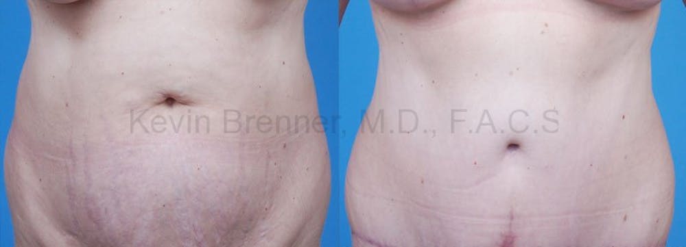 Tummy Tuck Before & After Gallery - Patient 1482452 - Image 1