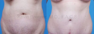 Tummy Tuck Before & After Gallery - Patient 1482452 - Image 1