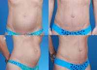 Umbilical Hernia Repair Before & After Gallery - Patient 1482453 - Image 1