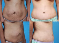 Before and after of tummy tuck in Beverly Hills 5