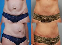 Umbilical Hernia Repair Before & After Gallery - Patient 1482455 - Image 1
