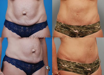 Umbilical Hernia Repair Before & After Gallery - Patient 1482455 - Image 1