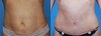 Tummy Tuck Before & After Gallery - Patient 1482456 - Image 1