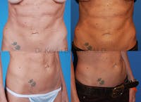 Umbilical Hernia Repair Before & After Gallery - Patient 1482458 - Image 1