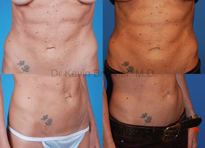 Umbilical Hernia Repair Before & After Gallery - Patient 1482458 - Image 1