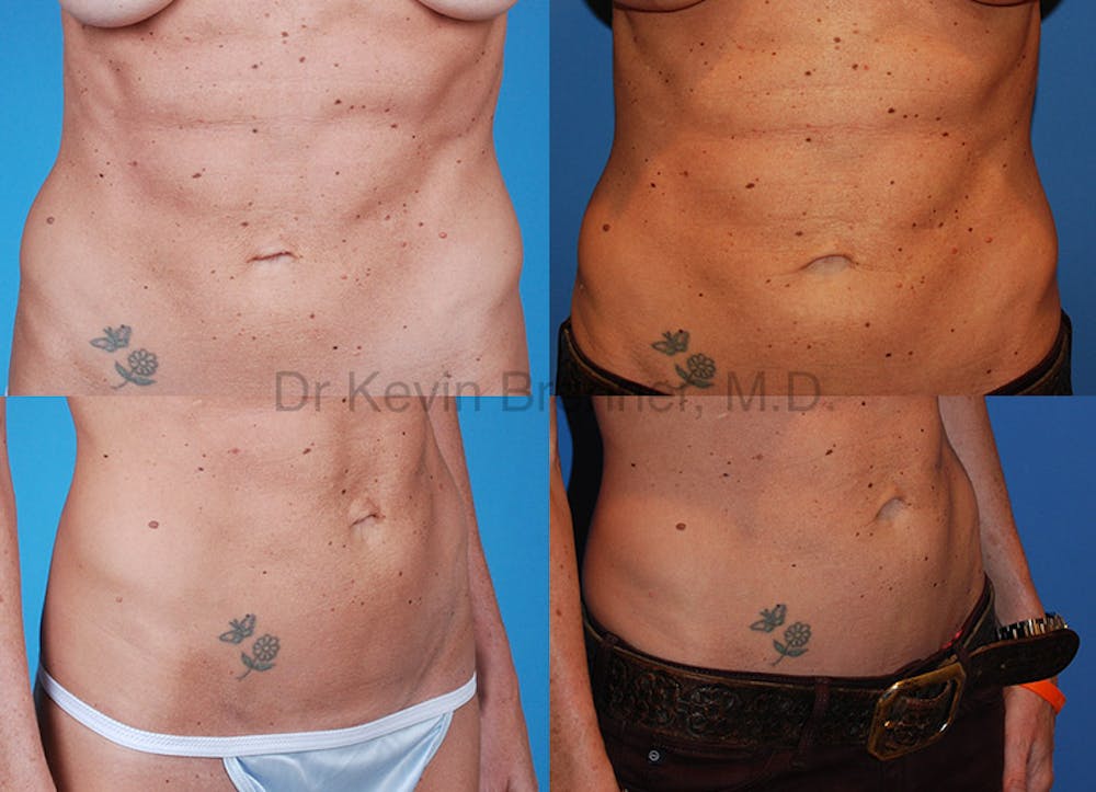 Umbilical Hernia Repair Before & After Gallery - Patient 1482458 - Image 1